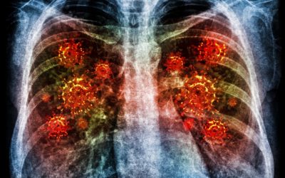 Pahami Komplikasi Pneumonia: Gejala, Penyebab, dan Pencegahan
