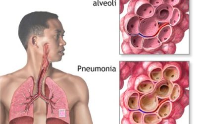 Penyuluhan Askep Pneumonia pada Dewasa: Asuhan Keperawatan yang Efektif