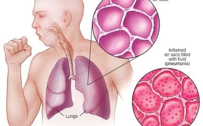 Terapi Non Farmakologi Pneumonia: Solusi Alami yang Efektif