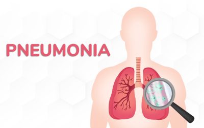 Memahami Latar Belakang Pneumonia dan Dampaknya bagi Kesehatan