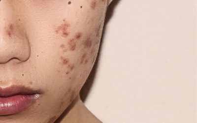 Apakah Begadang Dapat Menyebabkan Jerawat? Temukan Jawabannya di Sini