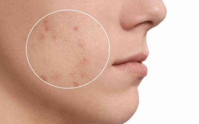 Berapa Harga Treatment Menghilangkan Bekas Jerawat? Temukan Jawabannya di Sini