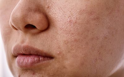 Manfaat Baby Cream Cusson untuk Perawatan Jerawat dan Kulit Sehat