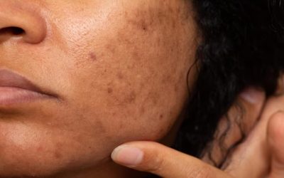 Apakah Darah Jerawat Najis atau Tidak? Pandangan Agama Islam Tentang Hal Ini