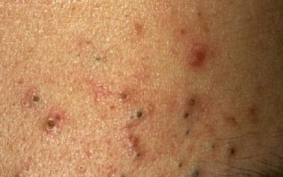 Penyebab Jerawat Hitam di Pipi dan Cara Alami Mengatasinya dengan Buah Merah