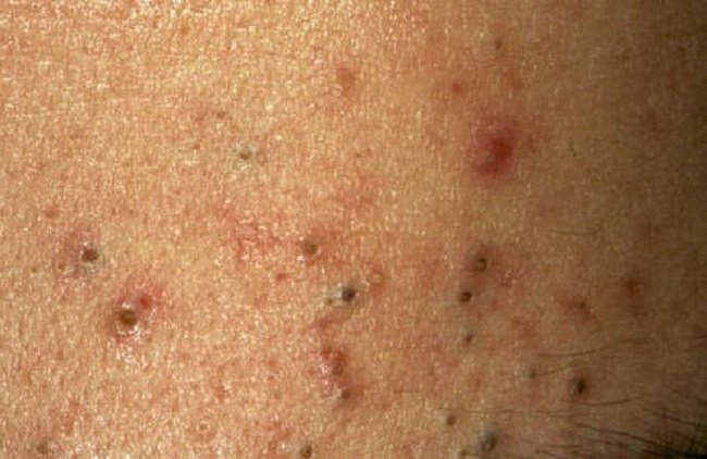 gambar-0-alodokter penyebab jerawat hitam di pipi