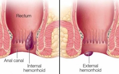 Tips Agar Luka Operasi Ambeien Cepat Kering dengan Dukungan Herbal Papua