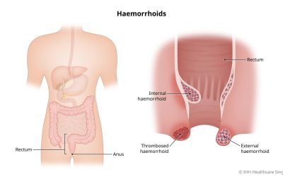 Ciri-Ciri Gejala Ambeien dan Manfaat Sarang Semut Papua untuk Mengatasinya