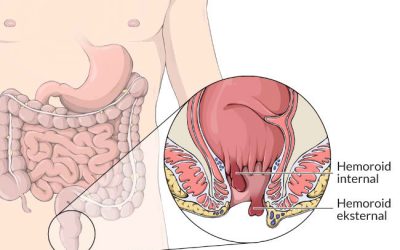 Ambeien Sembuh Berapa Lama? Faktor, Perawatan, dan Herbal Papua