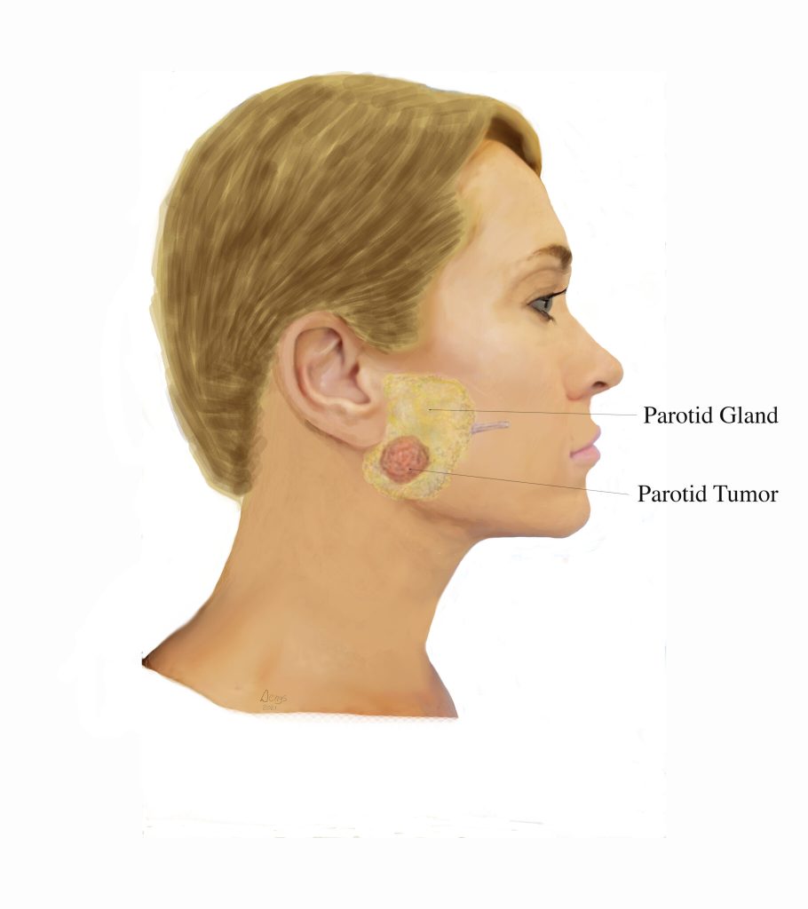 Recovery from parotid tumor surgery