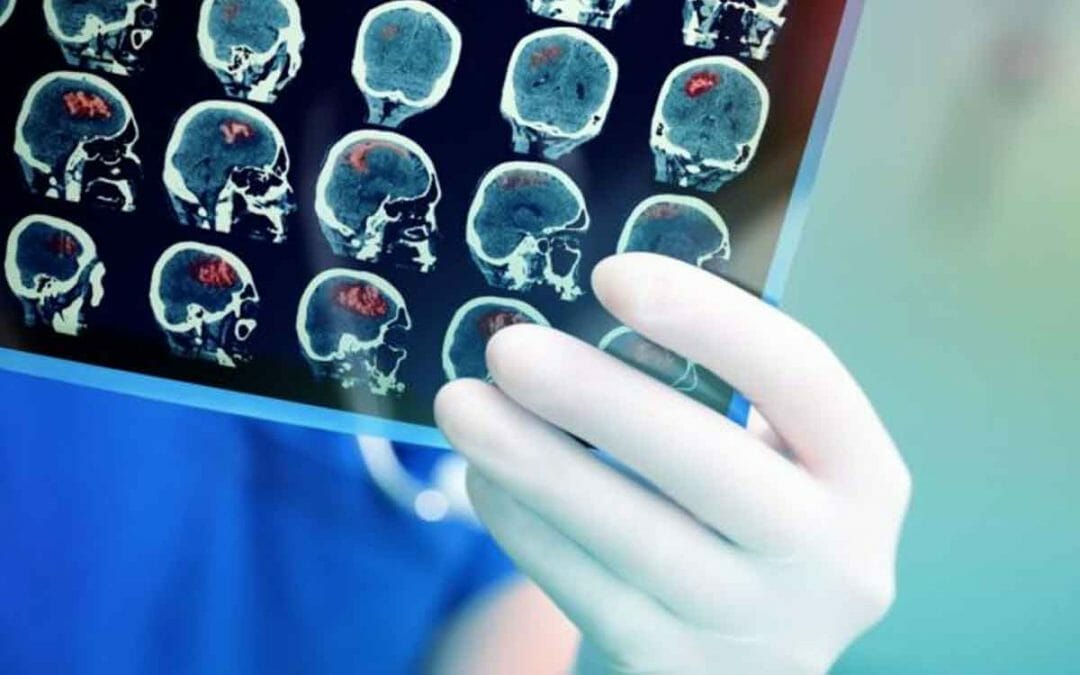 Pengertian Penyakit Stroke