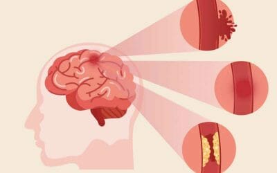 Jenis Penyakit Stroke Sesuai Dengan Gejala dan Kondisinya