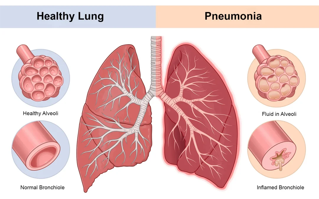 Apakah Pneumonia Bisa Sembuh Total? Ini Penjelasan Medisnya