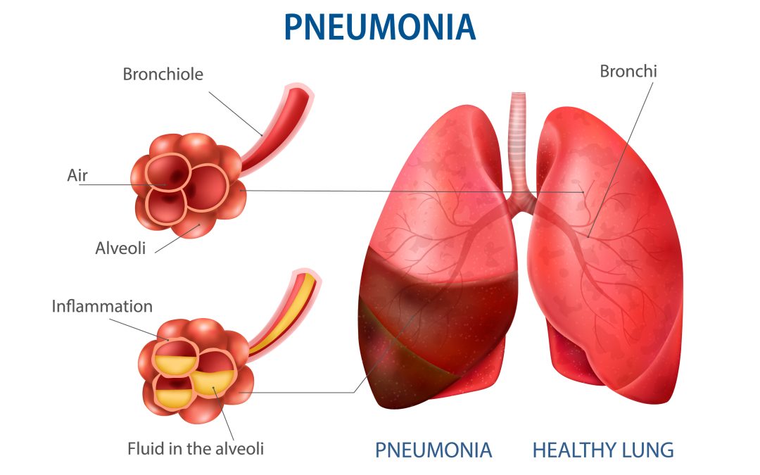 Cara Mencegah Pneumonia: Tips dan Langkah-langkah Penting