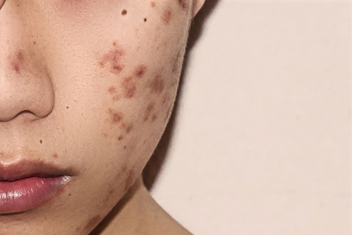 63b80b3483002 apakah begadang dapat menyebabkan jerawat