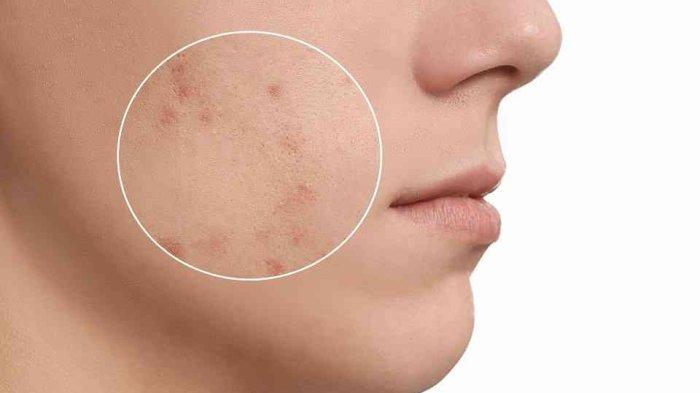 bekas-jerawat-1 harga treatment menghilangkan bekas jerawat