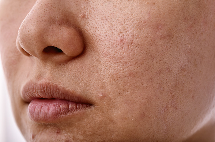 catat-ini-macam-macam-bekas-jerawat-dan-cara-mengatasinya manfaat baby cream cusson untuk jerawat