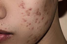 penyebab jerawat hitam di pipi