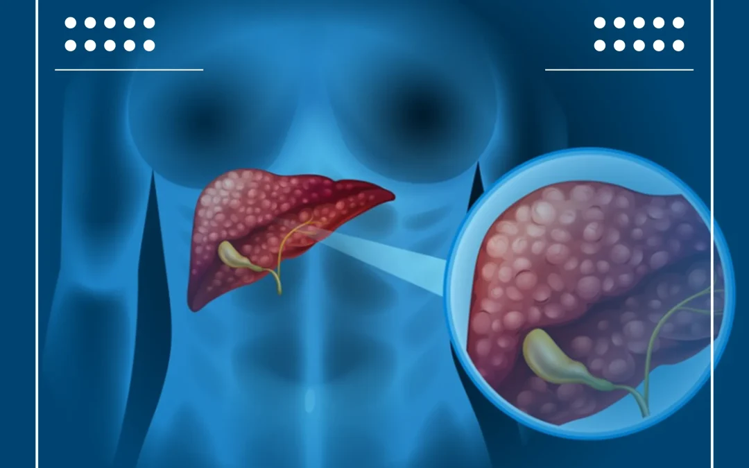 Tumor Hati Stadium 4 — Pilihan Terapi & Peran Obat Herbal