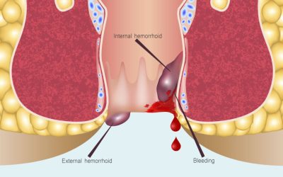 Can I Pop a Hemorrhoid? What Happens and What to Do Instead