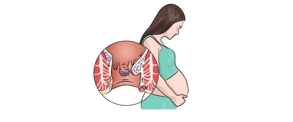how to get rid of a hemorrhoid while pregnant
